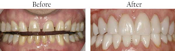 Punta Gorda Before and After Dental Implants