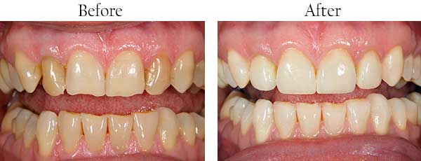Punta Gorda Before and After Teeth Whitening