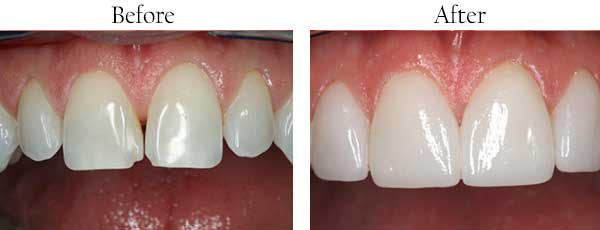 Punta Gorda Before and After Teeth Whitening
